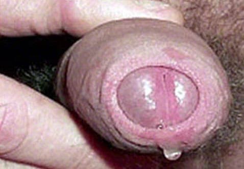 Infecção por clamídia