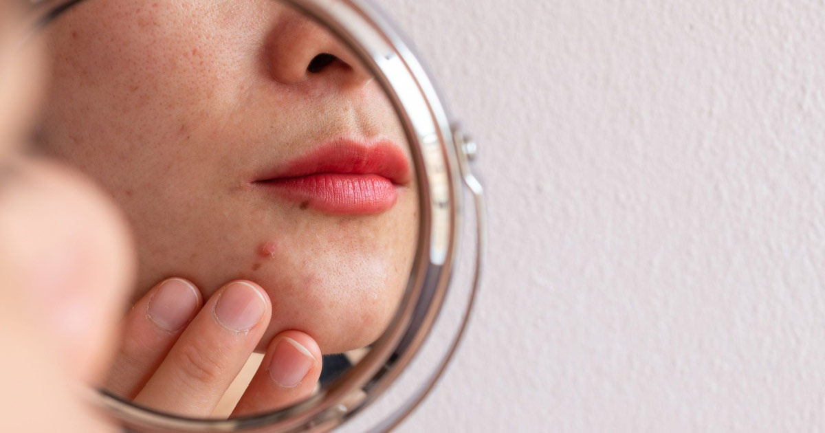 Reflexão no espelho de acne no queixo de uma mulher. 