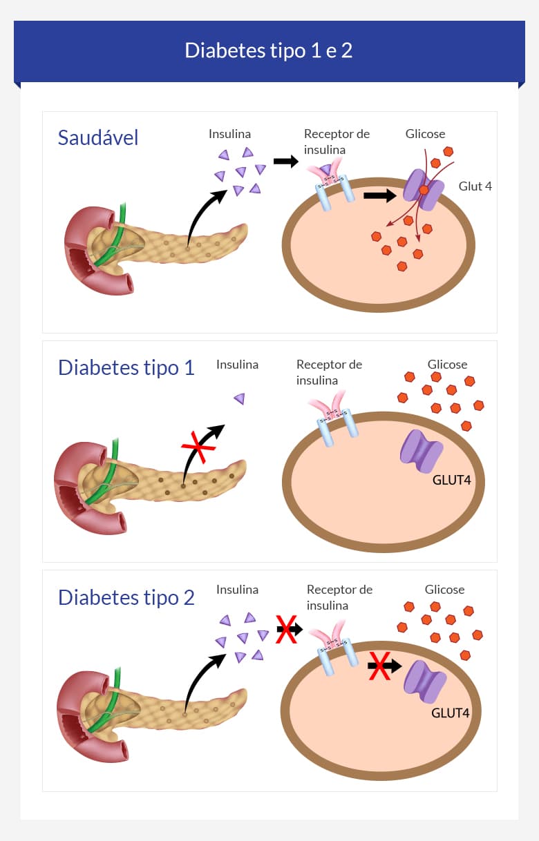 Diabetes tipo 1 e 2