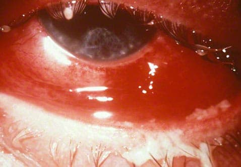 Infecção por gonorreia no olho