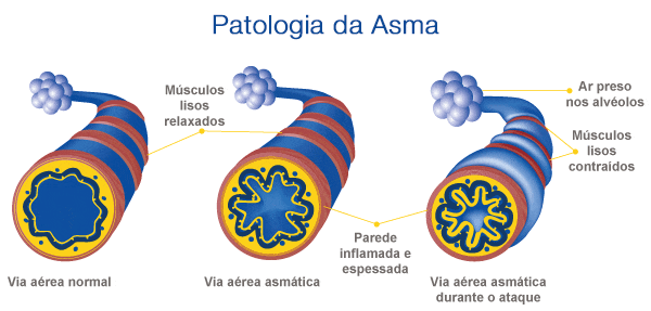 patologia da asma