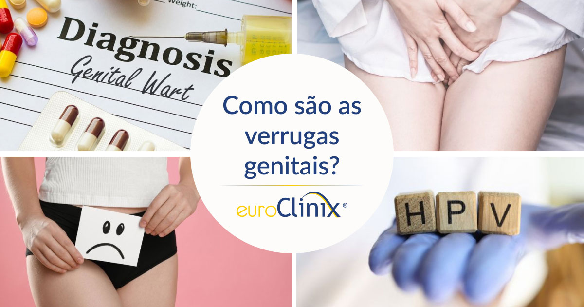 Colagem para um artigo intitulado: Como são as verrugas genitais?