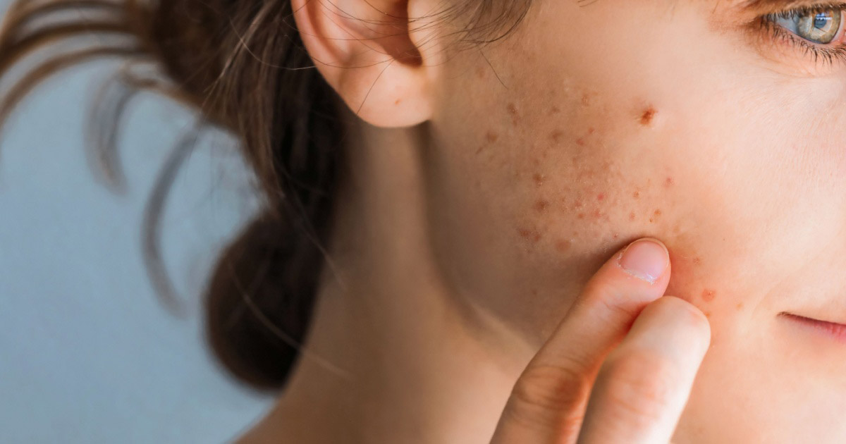 Mulher jovem com acne no rosto.