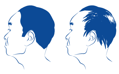 bild på hur Alopecia Effluviem kan se ut