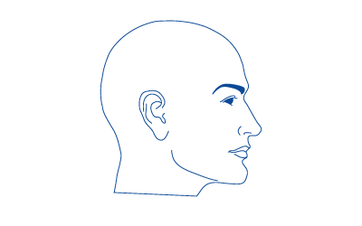 bild på hur Alopecia Totalis kan se ut