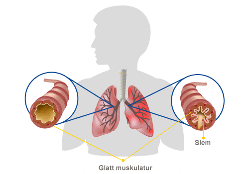 ansträngningsutlöst astma