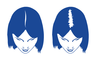 bild på Diffus Alopecia