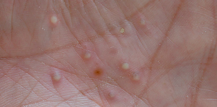 Ett galleri med bilder som visar olika typer av psoriasis