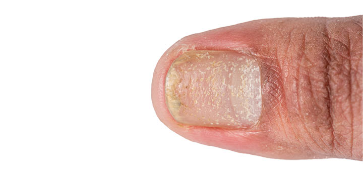 Ett galleri med bilder som visar olika typer av psoriasis